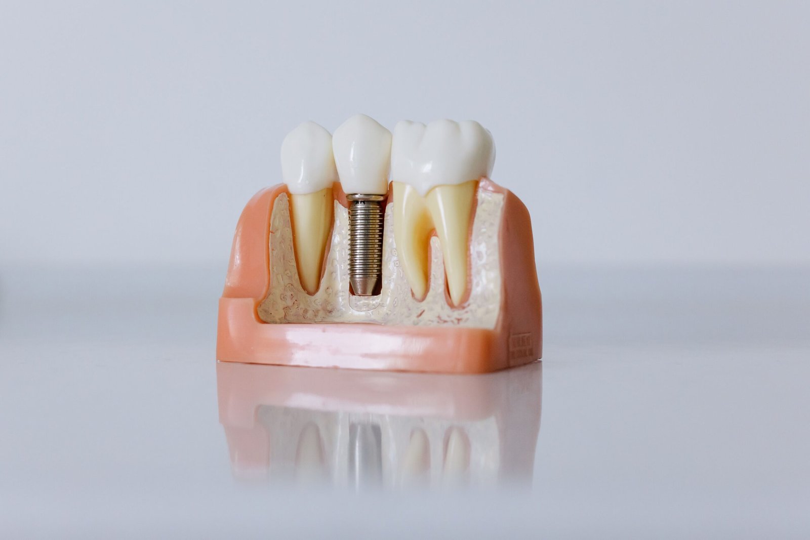 A close-up photograph of a detailed dental implant model displaying artificial teeth and gum structure