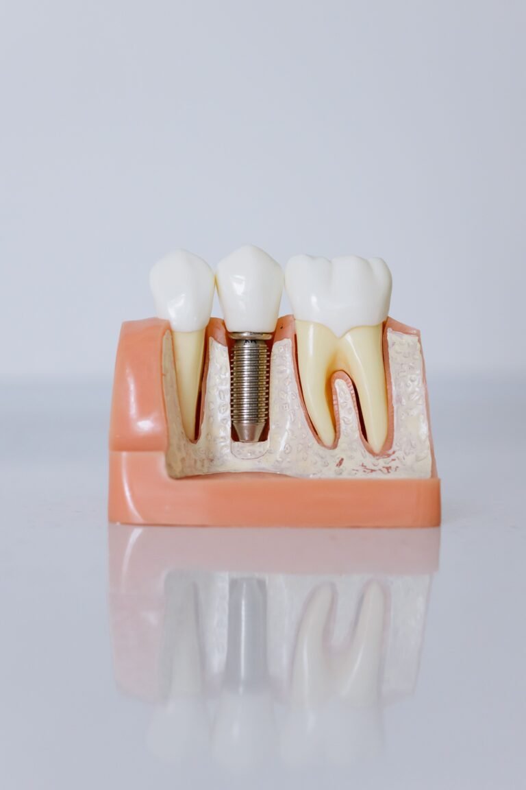 A detailed dental implant model showing teeth and gum anatomy used for patient education.