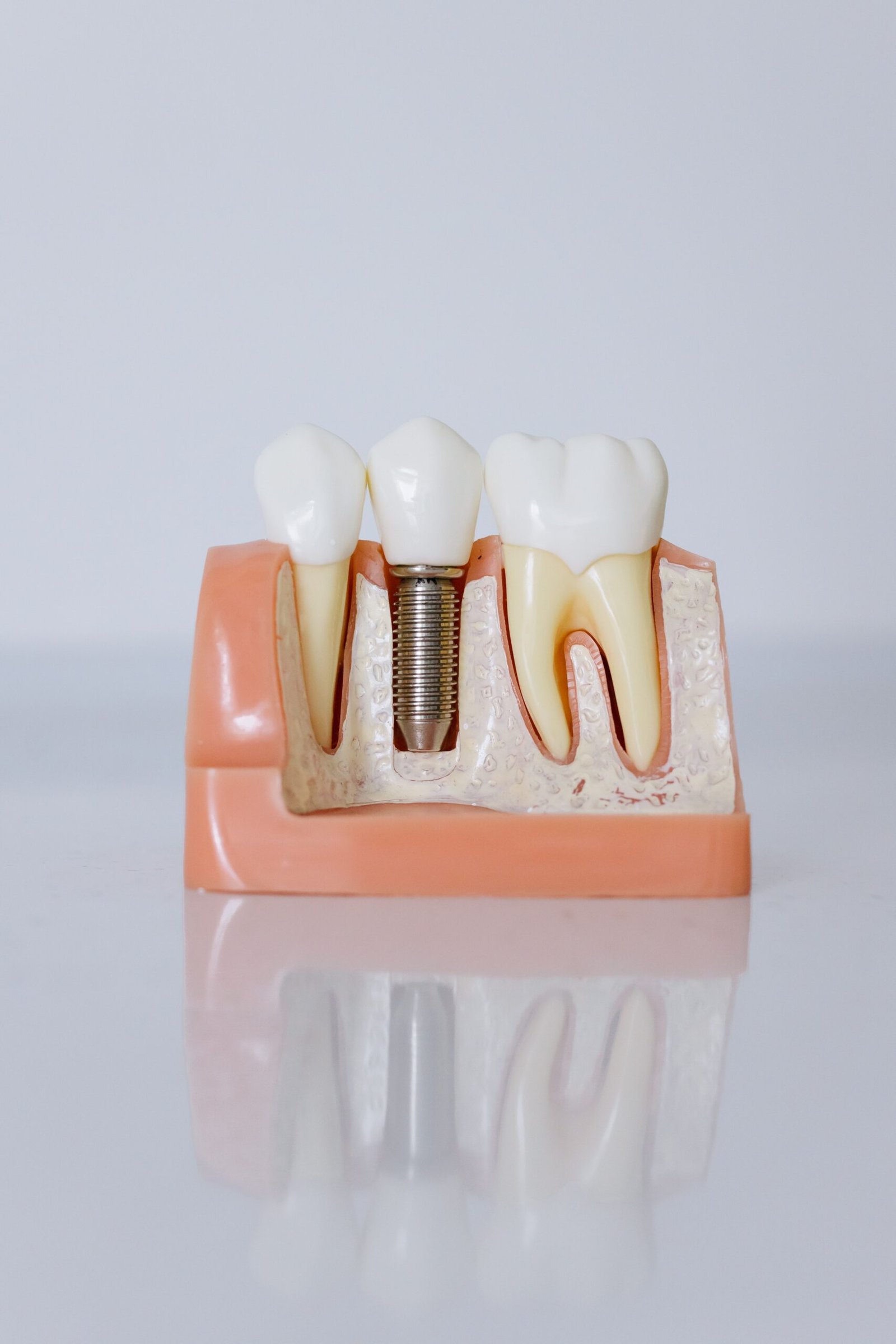 A detailed dental implant model showing teeth and gum anatomy used for patient education.